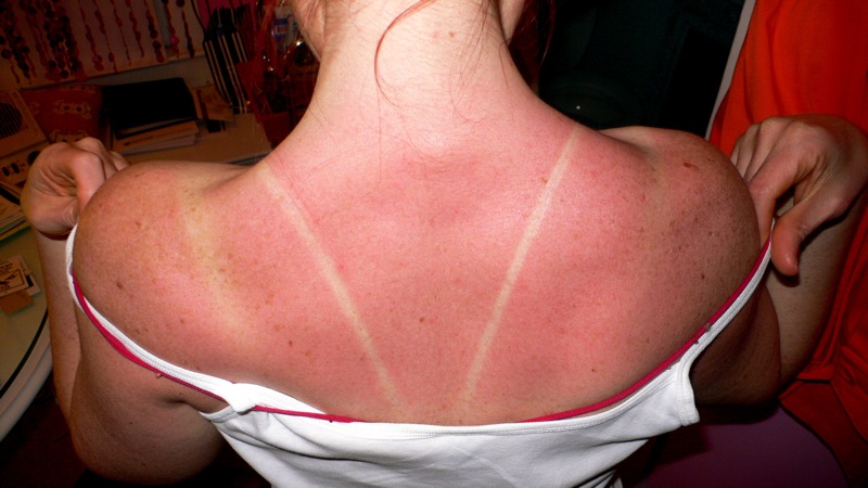 Sunburn_-131417495-